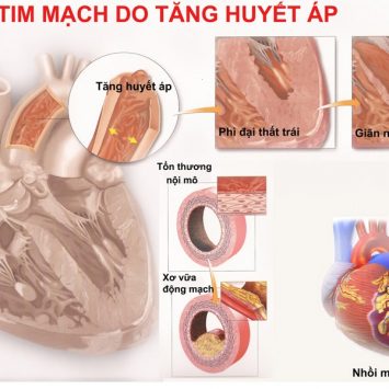 Tăng huyết áp – ‘Kẻ giết người thầm lặng’ ?